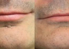 DermaRenew – Microneedle Skin Repair Patch