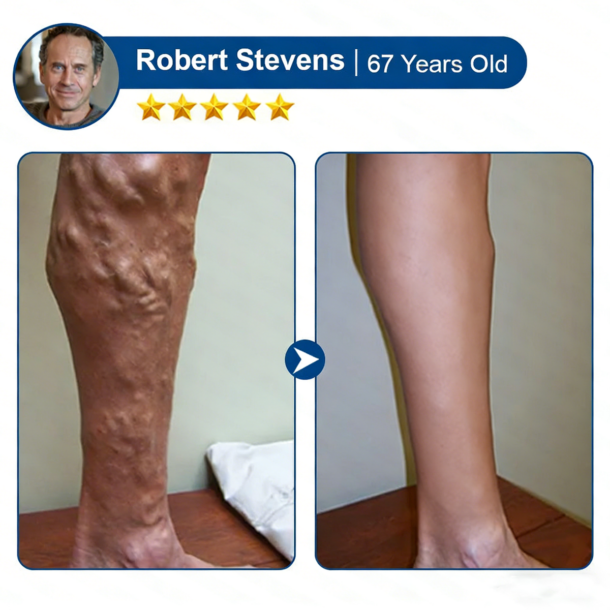 VenoLume – Diosmin & Hesperidin Microneedle Vein Patch