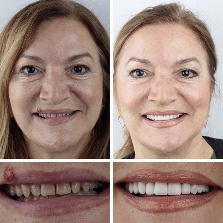 SmileRevive - Everyday Confidence Denture