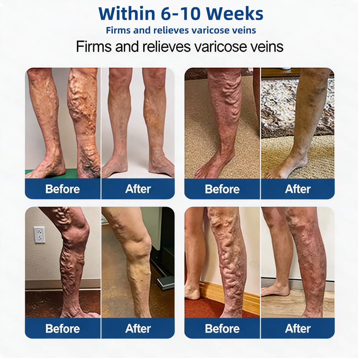 VenoLume – Diosmin & Hesperidin Microneedle Vein Patch