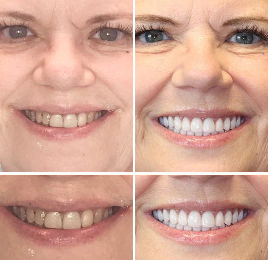 DentureFlex – Custom Mold Dentures