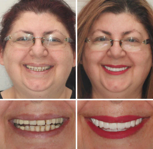 DentureFlex – Custom Mold Dentures