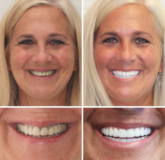 DentureFlex – Custom Mold Dentures