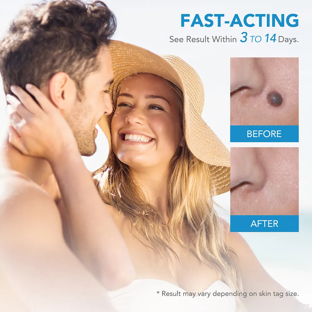 SkinRelief – Skin Tag Removal Ring Set